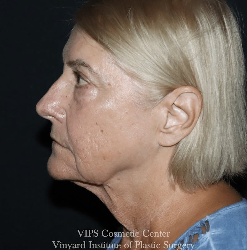 RF Microneedling Morpheus 8 Before & After Gallery - Patient 297697 - Image 2