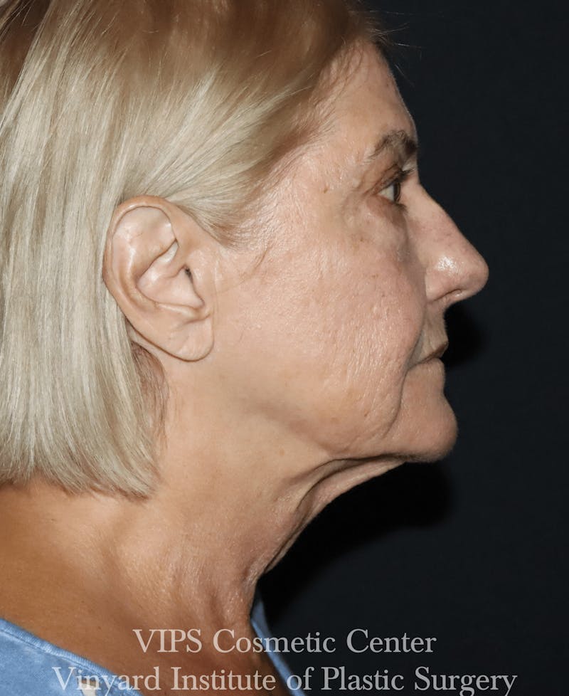 RF Microneedling Morpheus 8 Before & After Gallery - Patient 297697 - Image 4