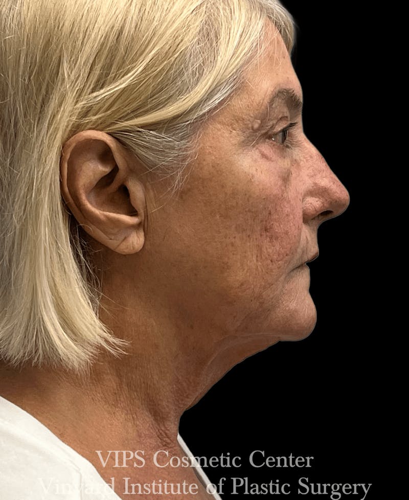 RF Microneedling Morpheus 8 Before & After Gallery - Patient 297697 - Image 3