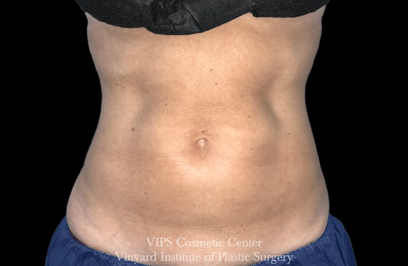 Morpheus8 BODY RF Microneedling Before & After Gallery - Patient 140160 - Image 2
