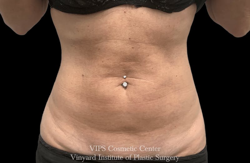 Morpheus8 BODY RF Microneedling Before & After Gallery - Patient 140160 - Image 1
