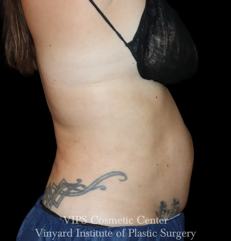 Coolsculpting ELITE Before & After Gallery - Patient 136800 - Image 1