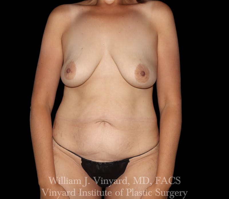 Mommy Makeover Before & After Gallery - Patient 129454 - Image 1