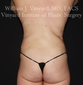 BodyTite Before & After Gallery - Patient 116758 - Image 6