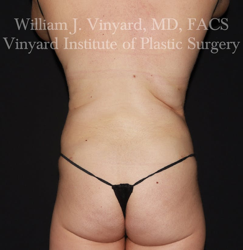 BodyTite Before & After Gallery - Patient 116758 - Image 6