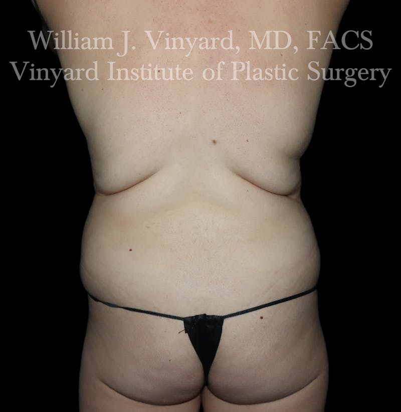 BodyTite Before & After Gallery - Patient 116758 - Image 5