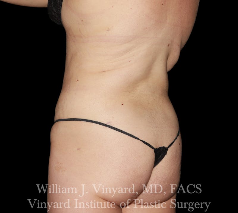 BodyTite Before & After Gallery - Patient 116758 - Image 8