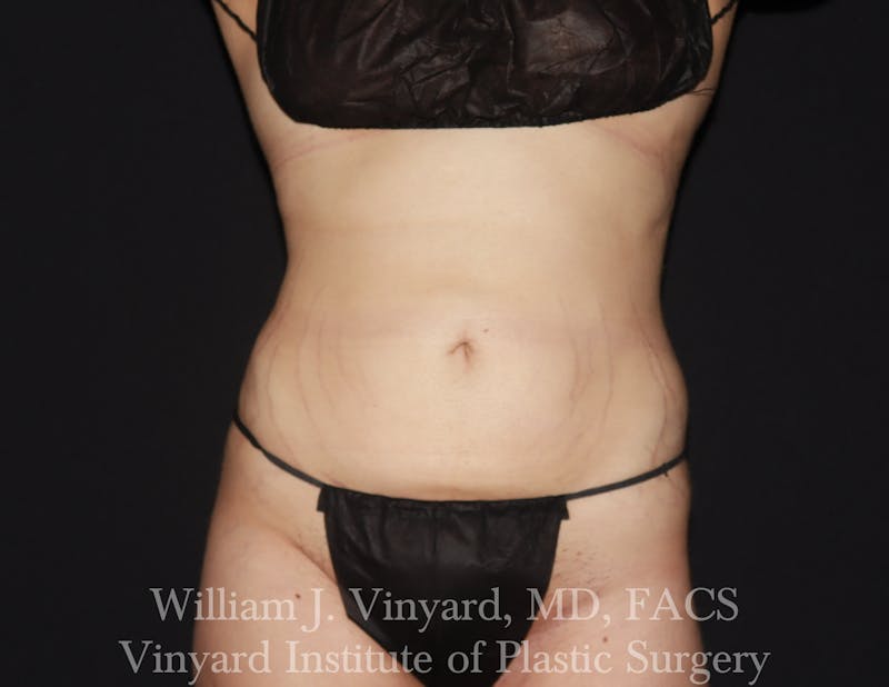 BodyTite Before & After Gallery - Patient 116758 - Image 2