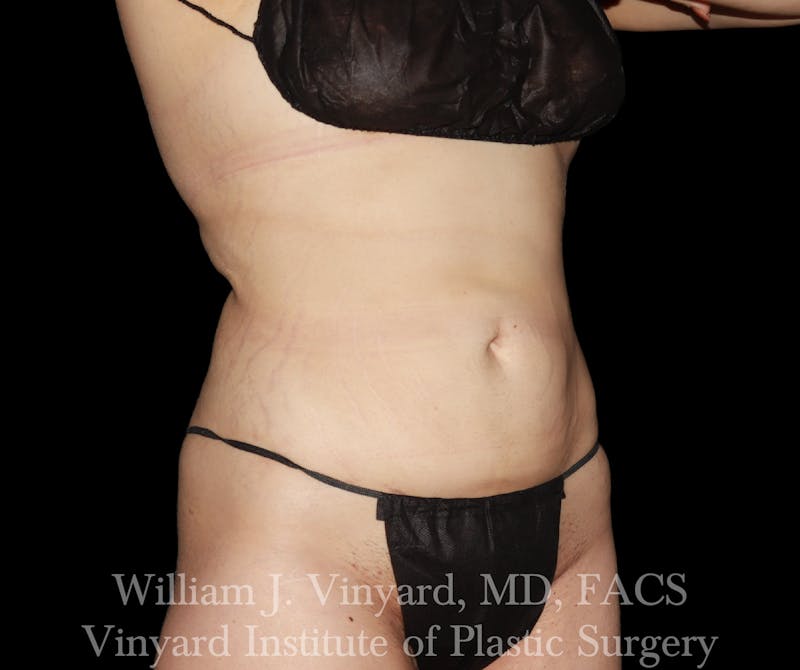 BodyTite Before & After Gallery - Patient 116758 - Image 4