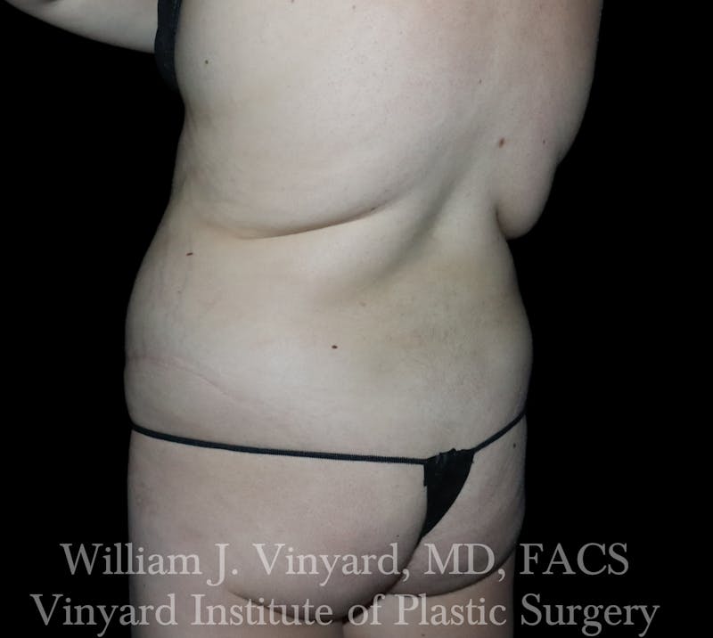 BodyTite Before & After Gallery - Patient 116758 - Image 7
