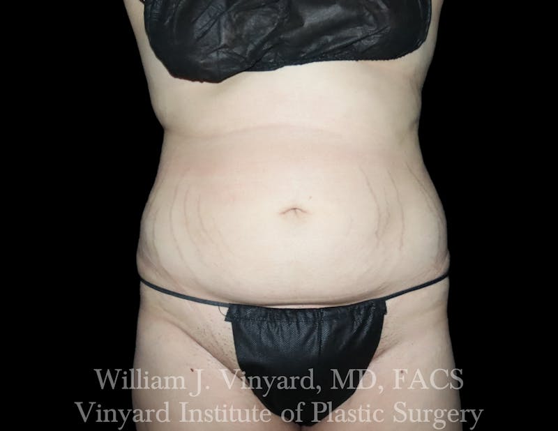 BodyTite Before & After Gallery - Patient 116758 - Image 1