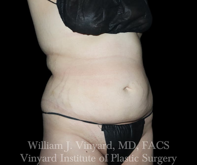 BodyTite Before & After Gallery - Patient 116758 - Image 3