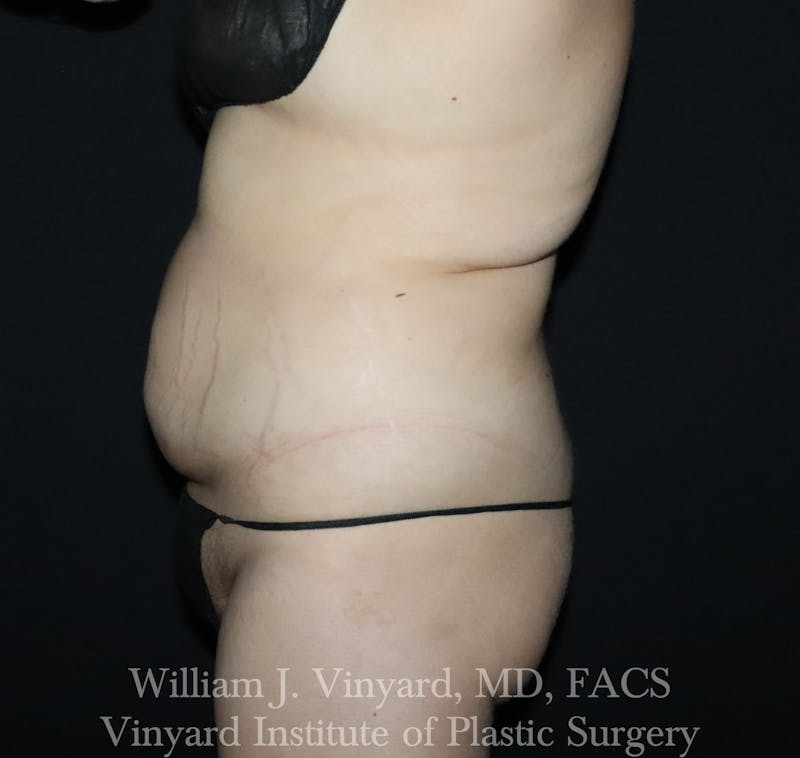 BodyTite Before & After Gallery - Patient 116758 - Image 9