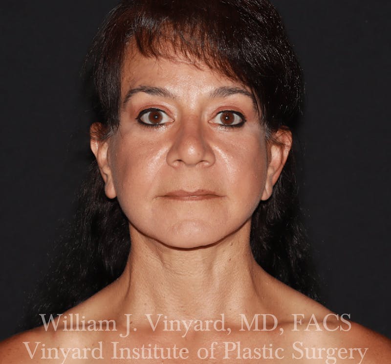 Facelift Before & After Gallery - Patient 259850 - Image 2