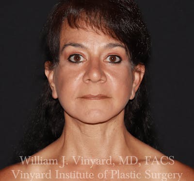 Facelift (Cheek and Neck Lift) Before & After Gallery - Patient 259850 - Image 2