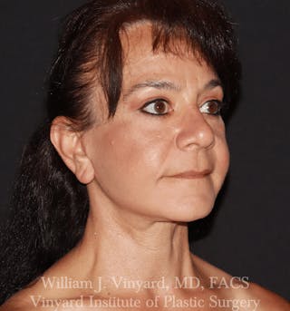Facelift Before & After Gallery - Patient 259850 - Image 6