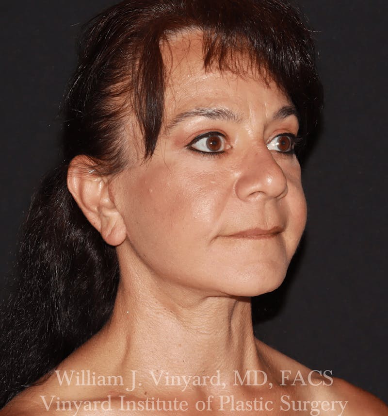 Facelift Before & After Gallery - Patient 259850 - Image 6