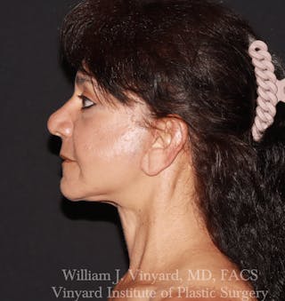Facelift Before & After Gallery - Patient 259850 - Image 8