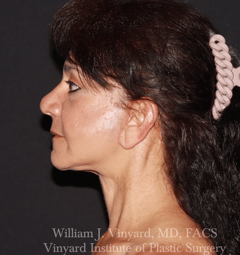 Facelift Before & After Gallery - Patient 259850 - Image 8