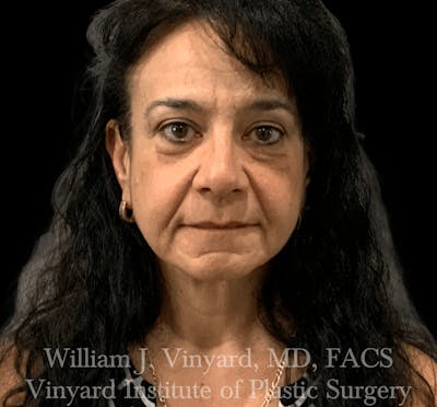 Facelift Before & After Gallery - Patient 259850 - Image 1