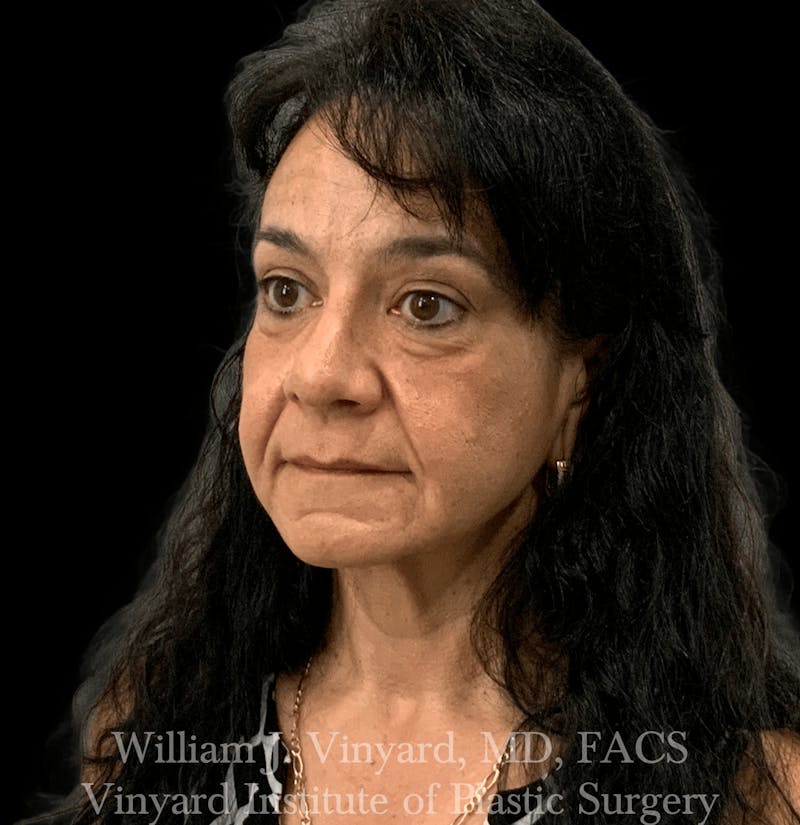 Facelift Before & After Gallery - Patient 259850 - Image 3