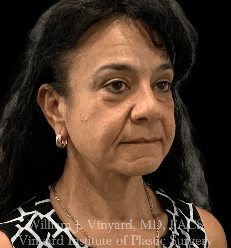 Facelift Before & After Gallery - Patient 259850 - Image 5