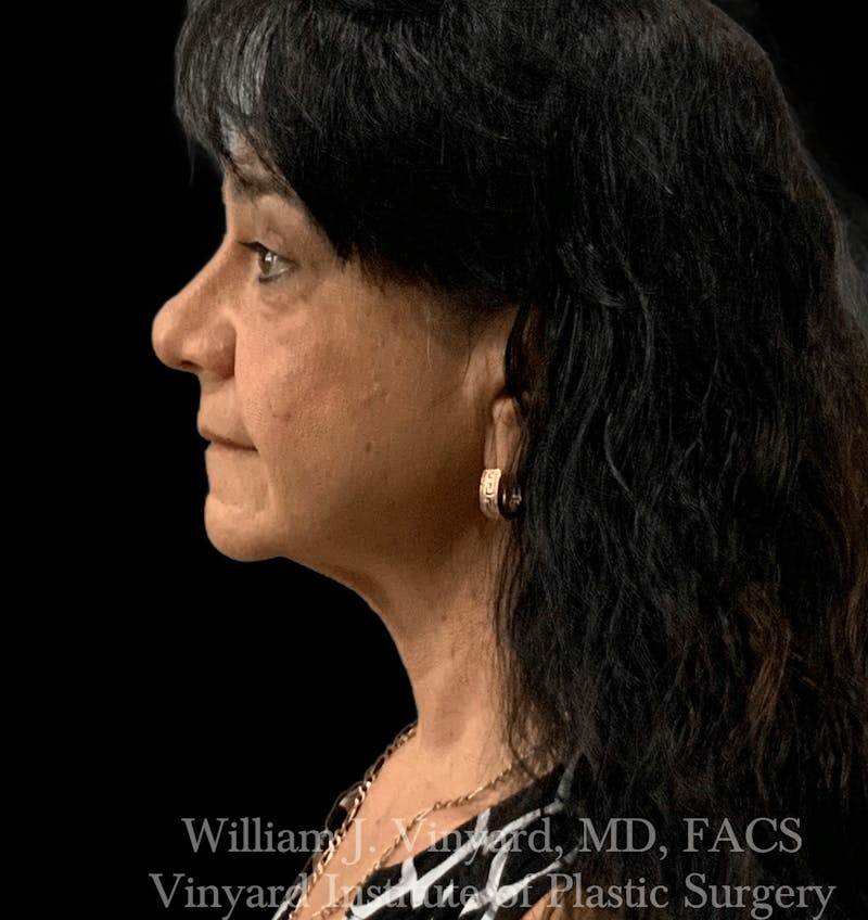 Facelift Before & After Gallery - Patient 259850 - Image 7