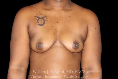 Breast Augmentation Before & After Gallery - Patient 178232 - Image 1