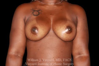 Liposuction Before & After Gallery - Patient 109730 - Image 2