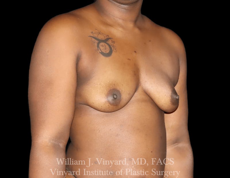 Liposuction Before & After Gallery - Patient 109730 - Image 5