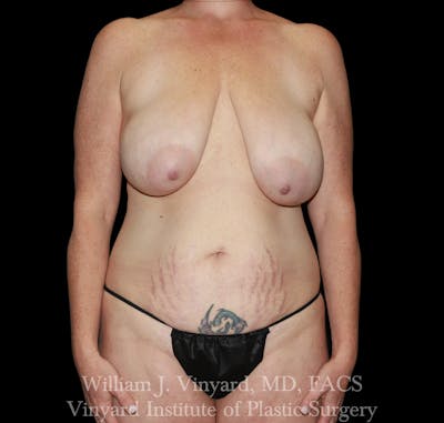 Mommy Makeover Before & After Gallery - Patient 350751 - Image 1