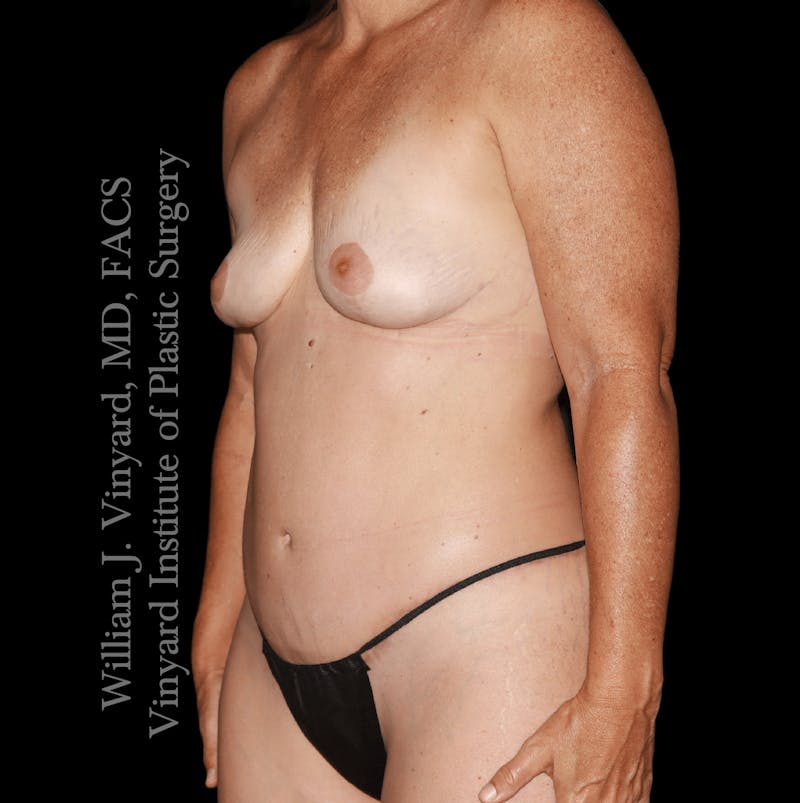 Mommy Makeover Before & After Gallery - Patient 438999 - Image 4