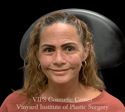 BOTOX® Before & After Gallery - Patient 380128 - Image 1