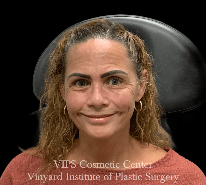 BOTOX® Before & After Gallery - Patient 380128 - Image 1
