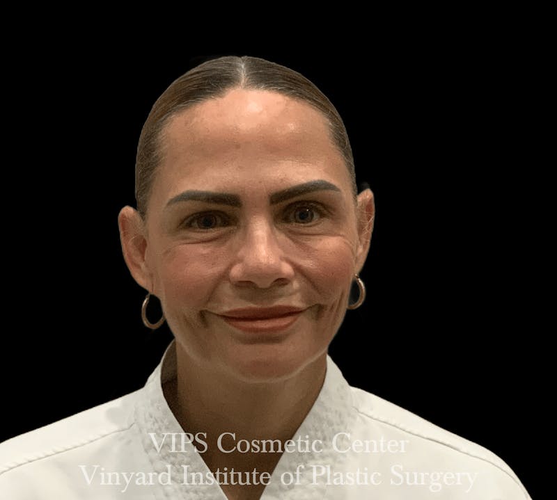 BOTOX® Before & After Gallery - Patient 380128 - Image 2