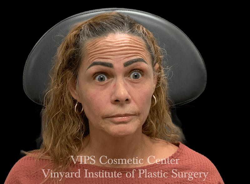 BOTOX® Before & After Gallery - Patient 380128 - Image 3
