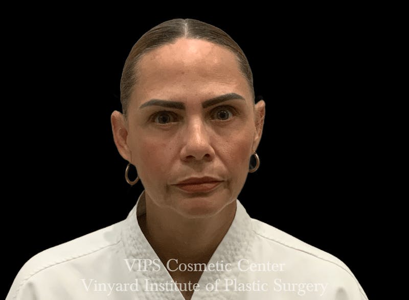 BOTOX® Before & After Gallery - Patient 380128 - Image 4