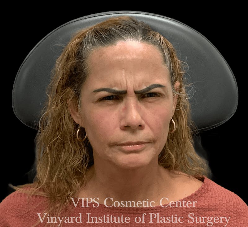 BOTOX® Before & After Gallery - Patient 380128 - Image 5