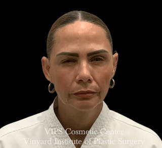 BOTOX® Before & After Gallery - Patient 380128 - Image 6