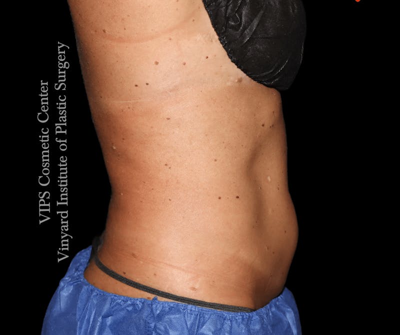 Coolsculpting ELITE Before & After Gallery - Patient 962645 - Image 3