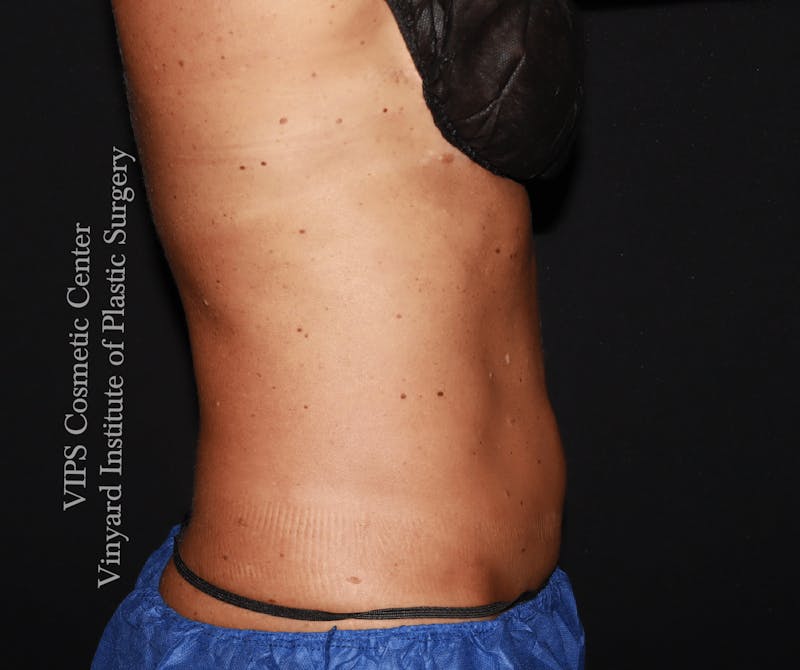 Coolsculpting ELITE Before & After Gallery - Patient 962645 - Image 4