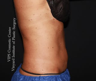 Coolsculpting ELITE Before & After Gallery - Patient 962645 - Image 4
