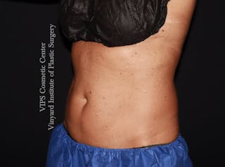 Coolsculpting ELITE Before & After Gallery - Patient 962645 - Image 6