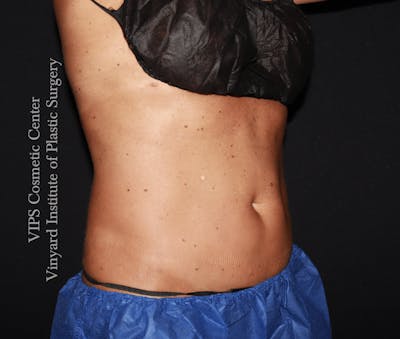 Coolsculpting ELITE Before & After Gallery - Patient 962645 - Image 2