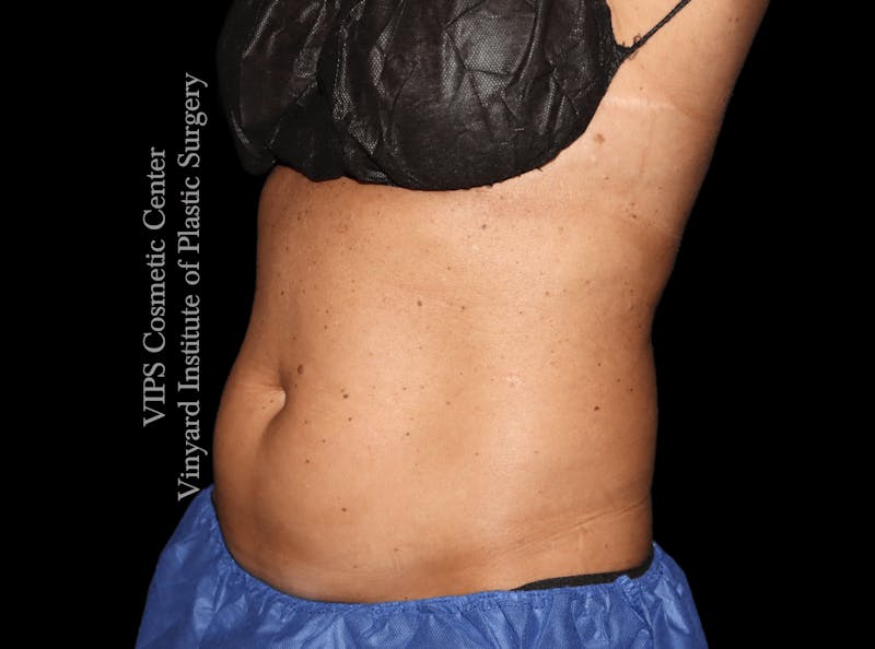 Coolsculpting ELITE Before & After Gallery - Patient 962645 - Image 5