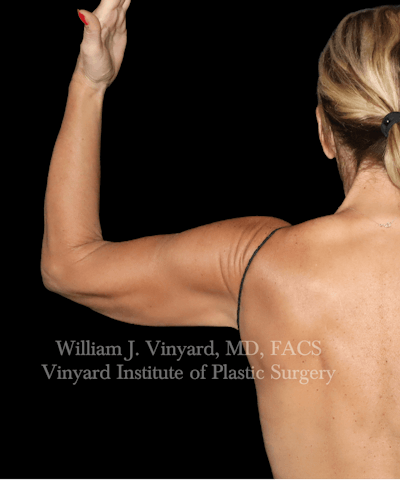Arm Lift Before & After Gallery - Patient 320972 - Image 1