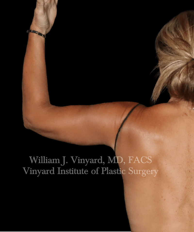 Arm Lift Before & After Gallery - Patient 320972 - Image 2