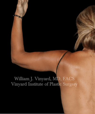 Arm Lift Before & After Gallery - Patient 320972 - Image 2