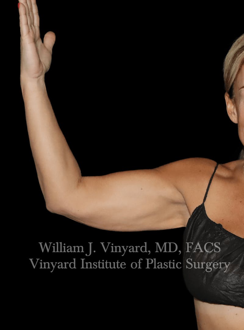 Arm Lift Before & After Gallery - Patient 320972 - Image 3