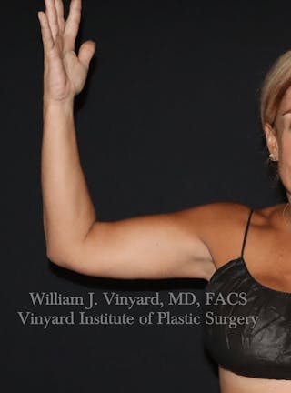 Arm Lift Before & After Gallery - Patient 320972 - Image 4